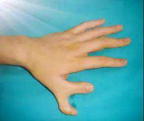 先天性手指畸形该怎么办？日常生活要注意什么呢？